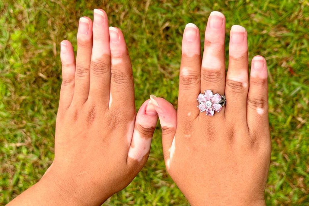 Conscientização: Dia Mundial do Vitiligo destaca tratamentos avançados no SUS